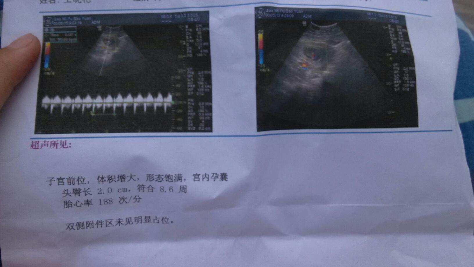 有姐妹能说说冻胚移植第九天成功的征兆有哪些吗